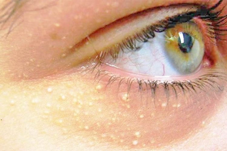 Pikat e bardha rreth syve – Çfarë tregojnë për shëndetin dhe trajtimet natyrale
