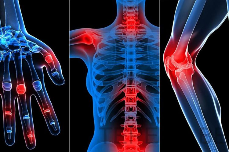 Artriti dhe artralgia – Sëmundjet që dëmtojnë kyçet dhe nyjat