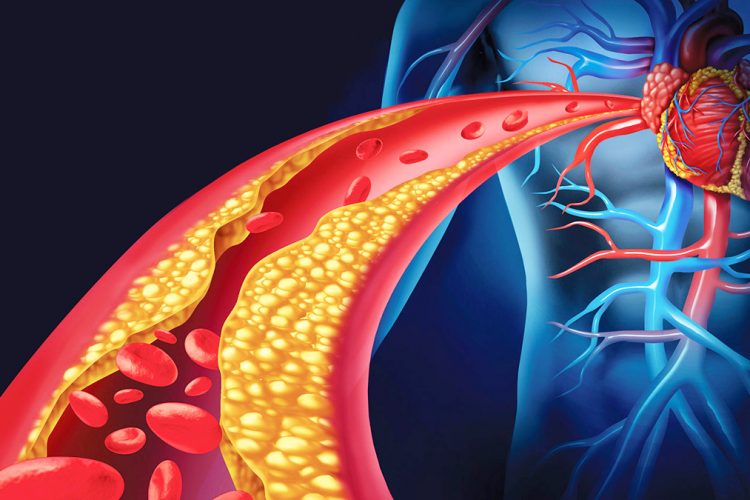 Dëmet që i shkakton kolesteroli i lartë zemrës dhe trurit – kujdesi që ju duhet