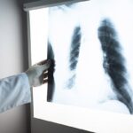 Në Ditën Botërore të Tuberkulozit, MSh ua rikujton qytetarëve se barnat janë falas